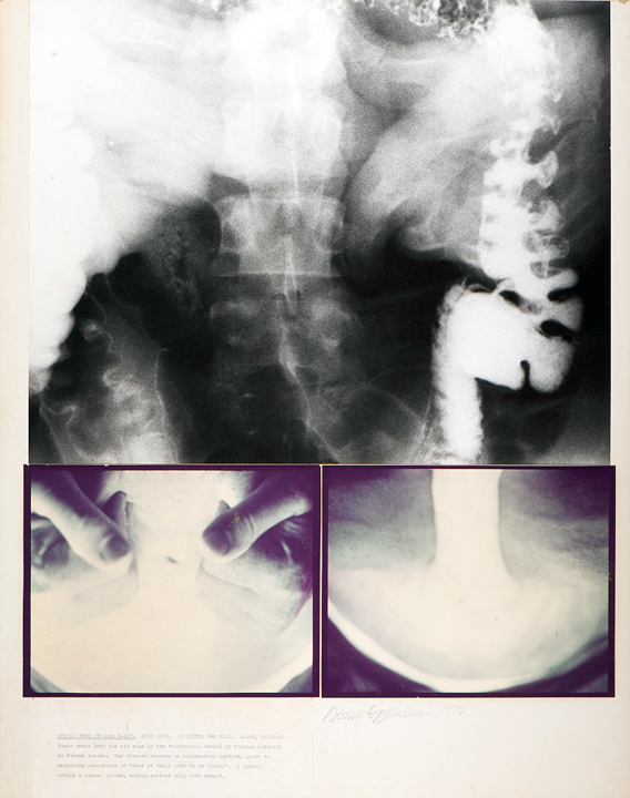 Oppenheim - Stomach X-ray